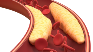 Veias com gordura acumulada, para falar sobre o colesterol