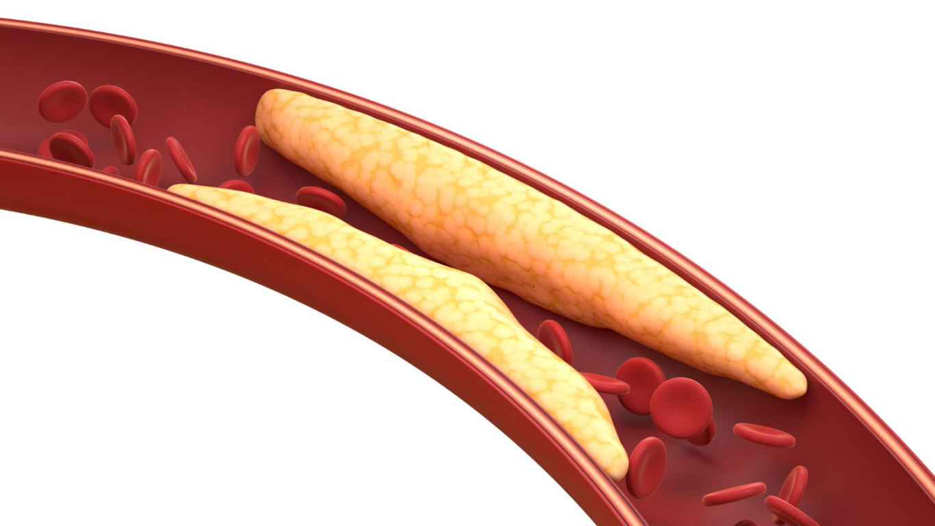 Artérias com placas de gordura acumuladas, indicando aterosclerose, que tem prevenção e tratamentos