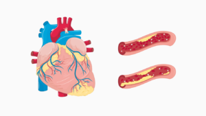 Desenho de coração com doença arterial coronariana