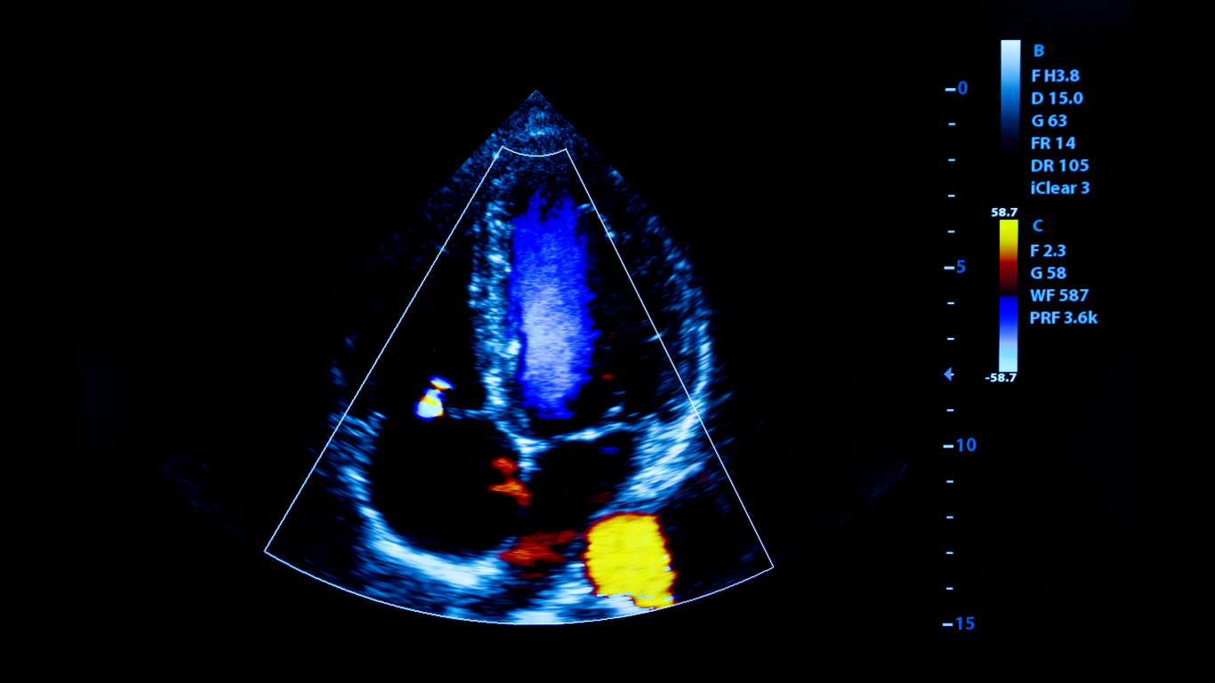 Ecocardiograma transtorácico, para falar sobre quando ele é necessário