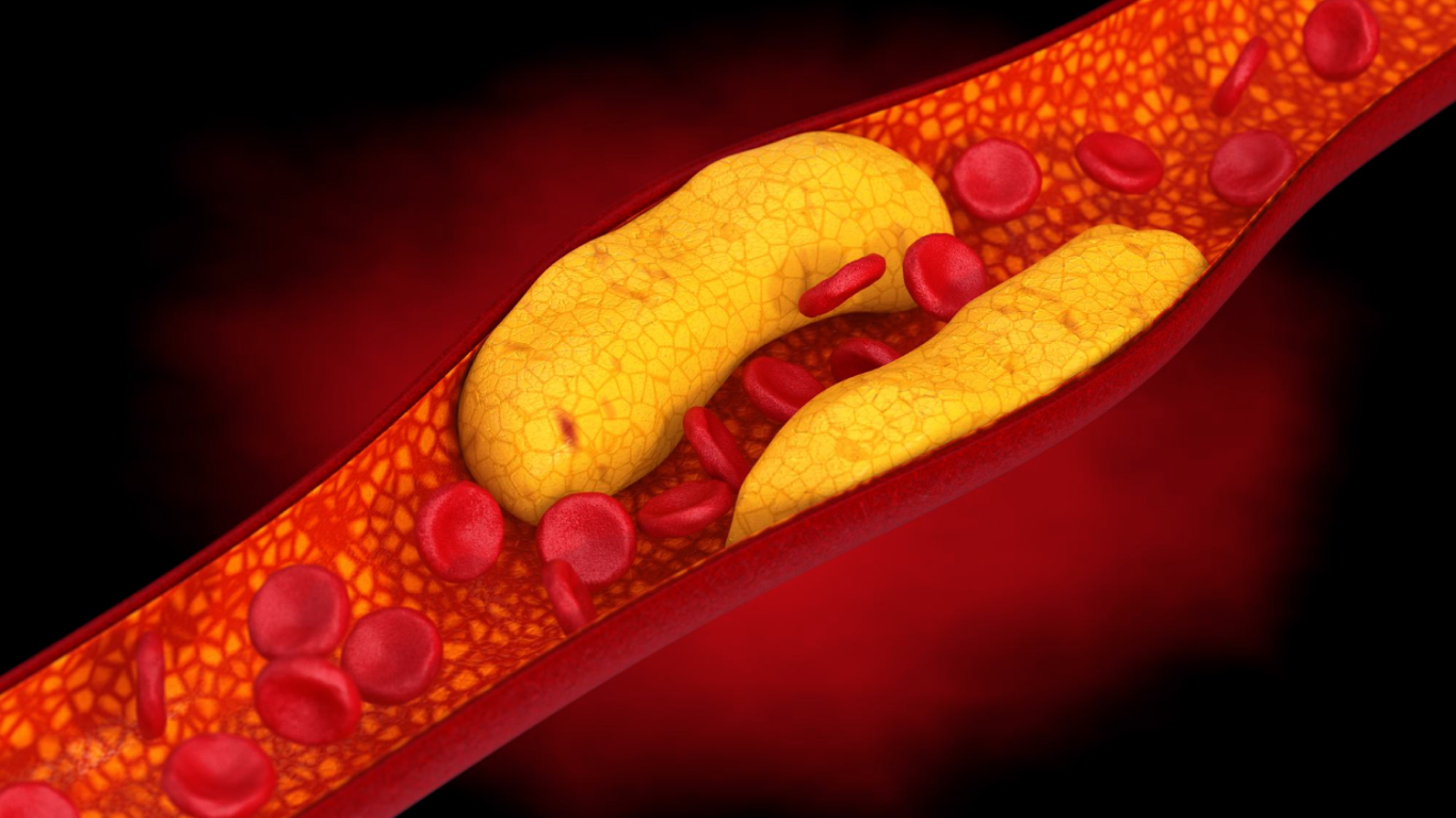 Artéria obstruída, para falar sobre a doença arterial coronariana